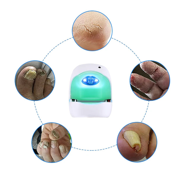 Toenail Fungus Nail Cleaning Laser device for onychomycosis 905nm laser 470nm blue light therapy nail fungus treatment