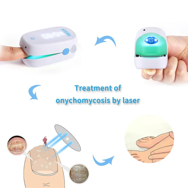 Toenail Fungus Nail Cleaning Laser device for onychomycosis 905nm laser 470nm blue light therapy nail fungus treatment